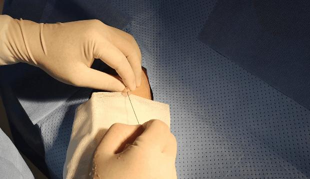 心脏造影和支架一起做大概多少钱,心脏造影支架视频全过程