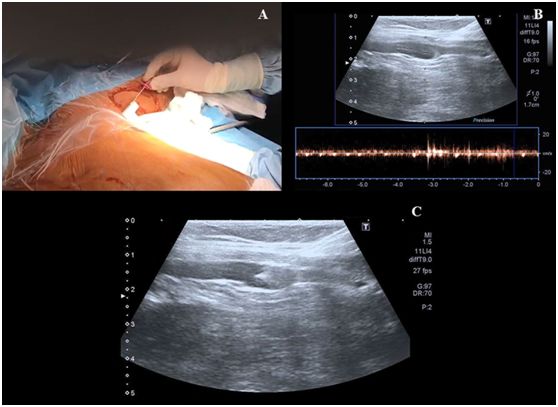 超声引导下腋静脉穿刺置管视频,超声引导腋静脉穿刺视频教程