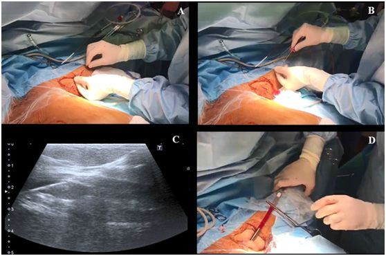超声引导下腋静脉穿刺置管视频,超声引导腋静脉穿刺视频教程