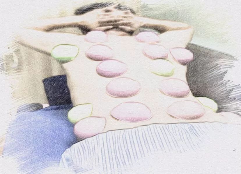 拔罐可以搞定哪些小毛病,拔罐疗法的适应症和作用