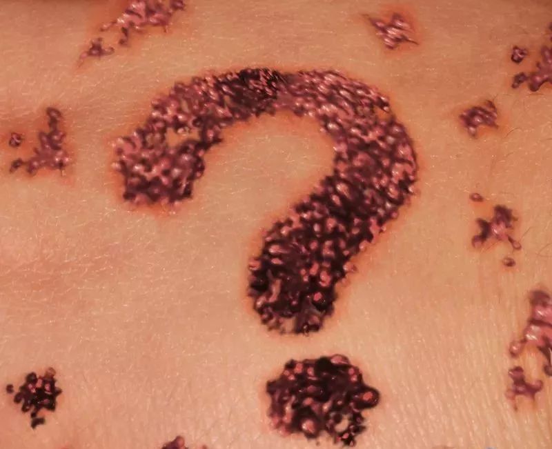 这样的痣可能变成癌中之王？把痣点掉能预防吗？