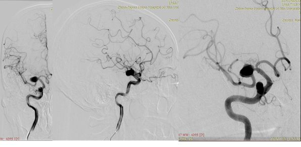 pipeline治动脉瘤,密网支架治疗动脉瘤原理
