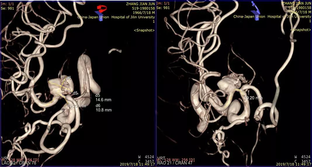 pipeline治动脉瘤,密网支架治疗动脉瘤原理