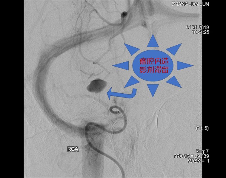 pipeline治动脉瘤,密网支架治疗动脉瘤原理