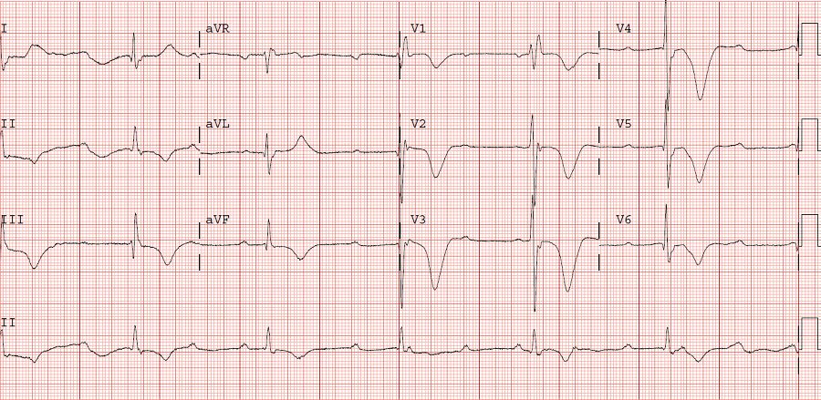 运动员t波改变怎么快速恢复正常,运动员会出现t波改变还能运动吗