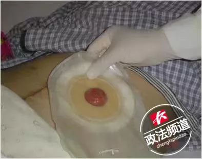 高压充气枪喷肛门?长沙小伙开玩笑差点要了同伴的命