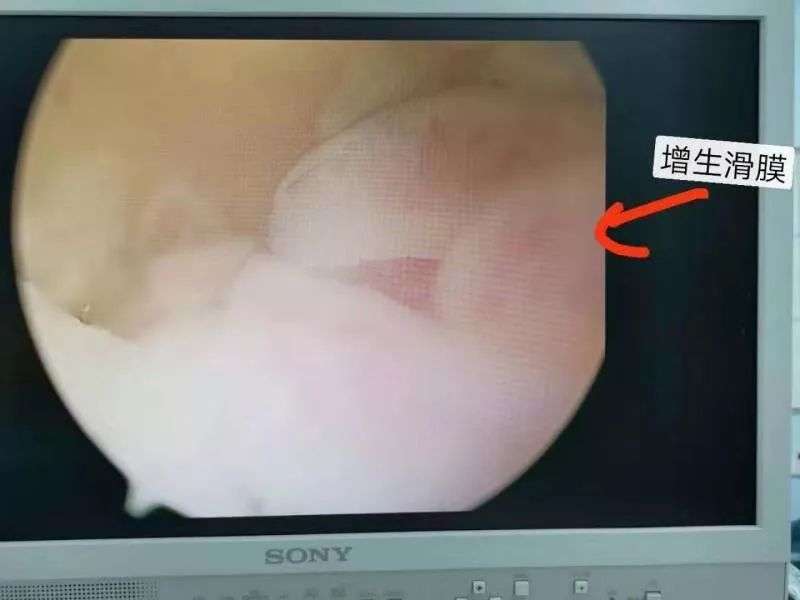 50岁女子手肘关节突然疼得动不了,医生手术取出一团“海绵”...