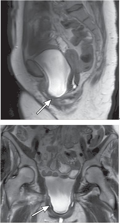 一文读懂:盆底功能障碍的影像学表现|临床实战
