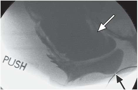 一文读懂:盆底功能障碍的影像学表现|临床实战