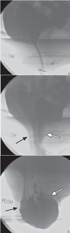 一文读懂:盆底功能障碍的影像学表现|临床实战