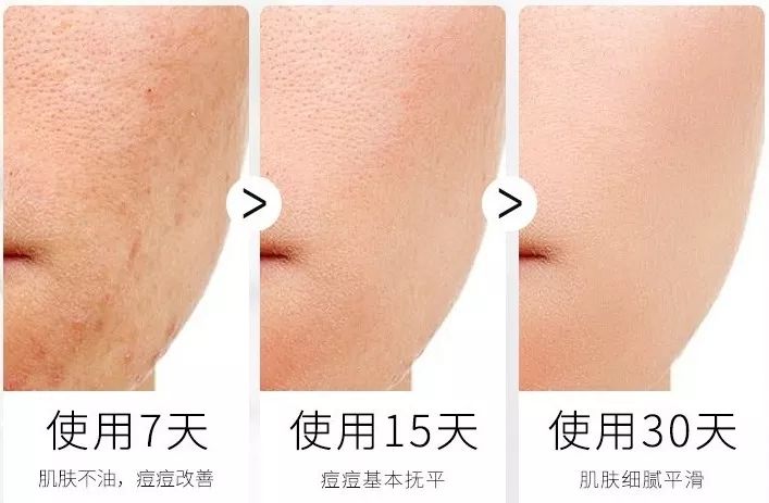 鼻头痘痘爆浆,鼻头痘痘挤出来的白色物质是什么