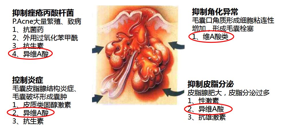异维a酸是抗痘神器吗,异维a酸软胶囊祛痘坑痘疤