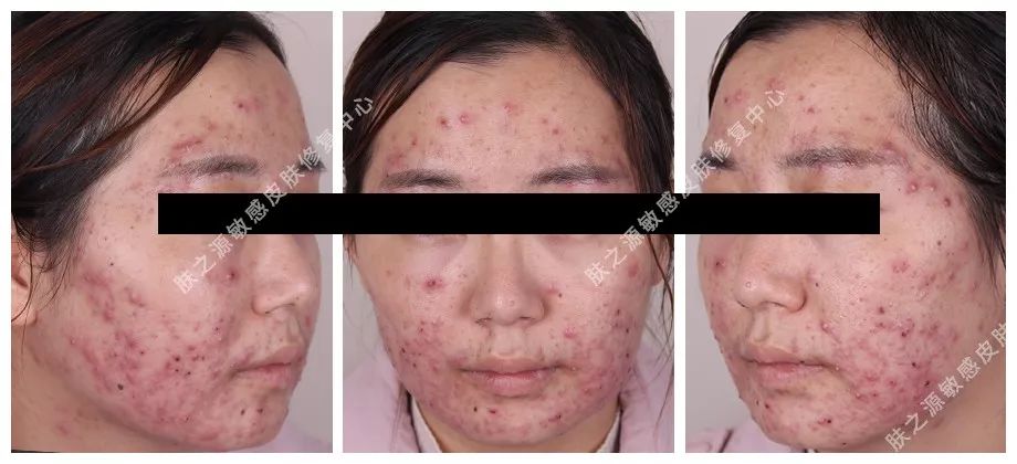 异维a酸是抗痘神器吗,异维a酸软胶囊祛痘坑痘疤