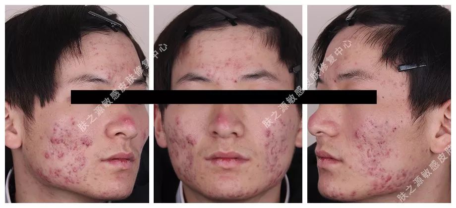 异维a酸是抗痘神器吗,异维a酸软胶囊祛痘坑痘疤