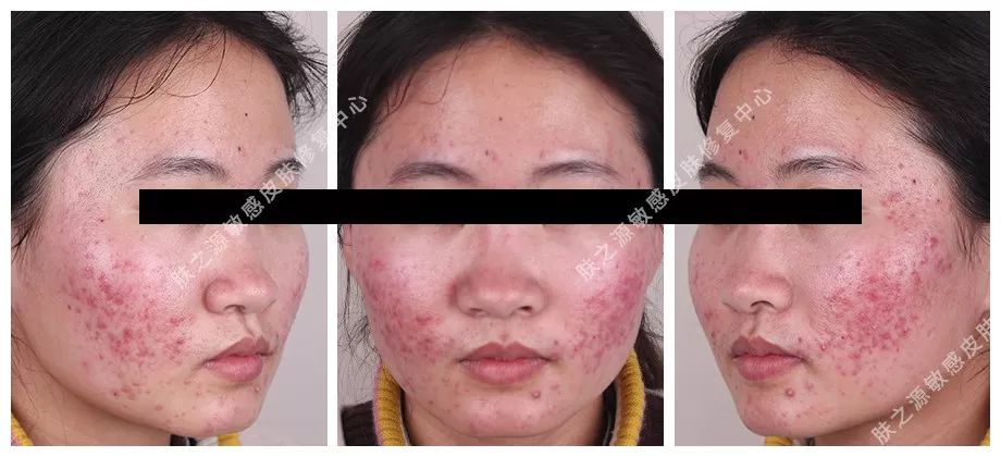 异维a酸是抗痘神器吗,异维a酸软胶囊祛痘坑痘疤