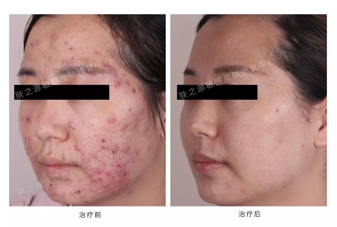 异维a酸是抗痘神器吗,异维a酸软胶囊祛痘坑痘疤