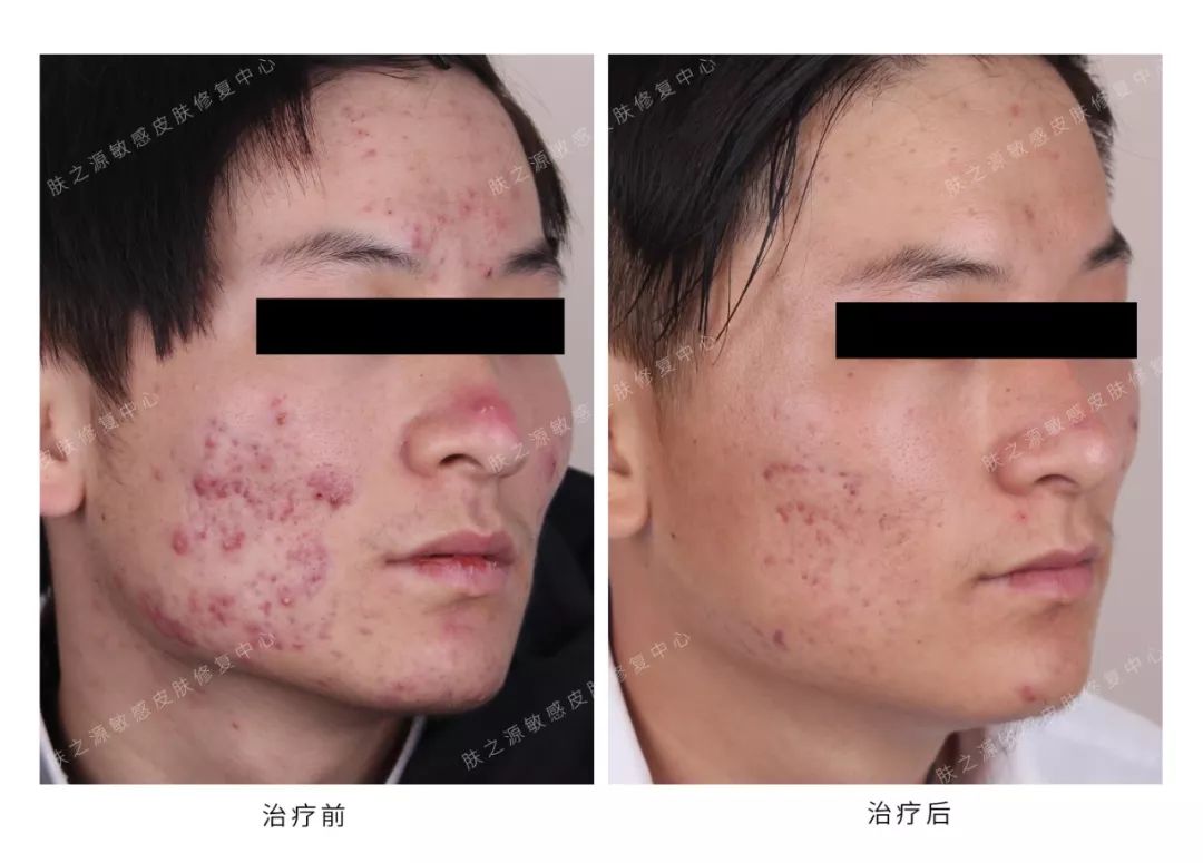 异维a酸是抗痘神器吗,异维a酸软胶囊祛痘坑痘疤