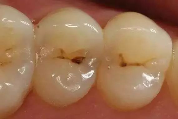 蛀牙要治疗几次才能成功,蛀牙到底该补还是该治疗