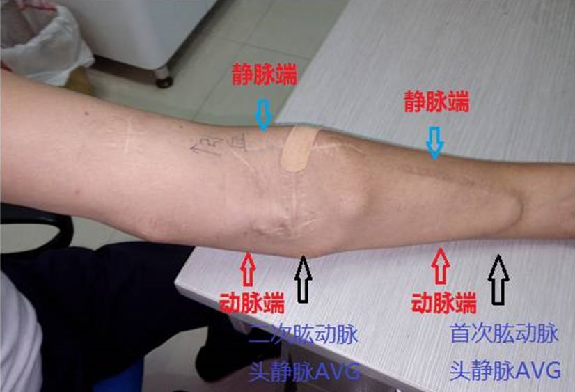 血透动静脉内瘘手术三种术式图解,血透室动静脉内瘘穿刺及护理