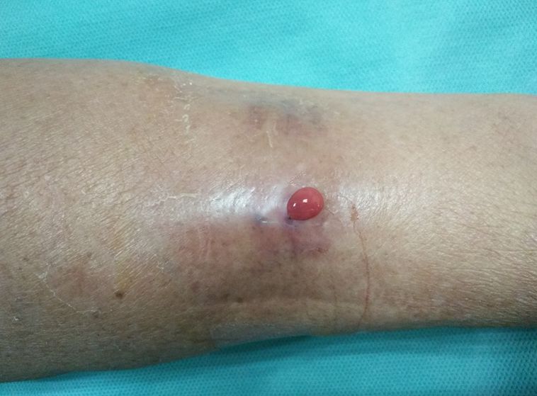 血透动静脉内瘘手术三种术式图解,血透室动静脉内瘘穿刺及护理