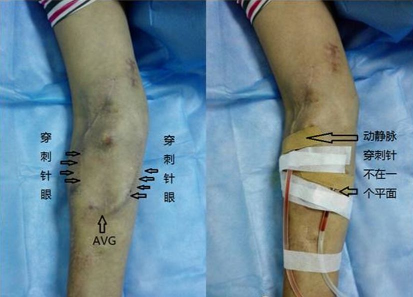 血透动静脉内瘘手术三种术式图解,血透室动静脉内瘘穿刺及护理