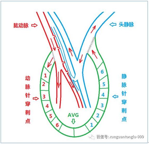 血透动静脉内瘘手术三种术式图解,血透室动静脉内瘘穿刺及护理