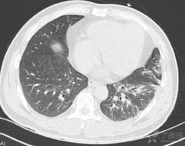 中午冷水澡，晚上高热，2天后休克，病因意想不到