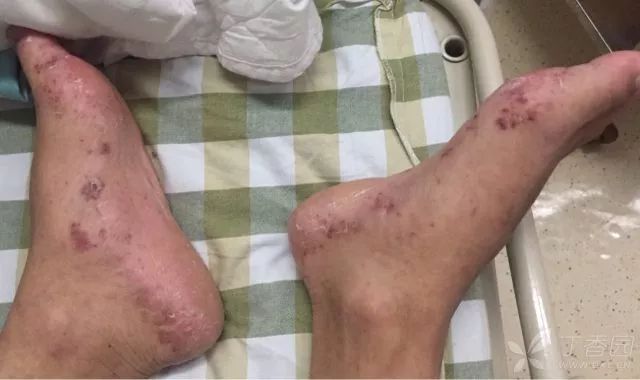 中午冷水澡，晚上高热，2天后休克，病因意想不到