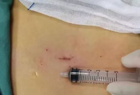 看着就疼！11岁男孩觉得要害部位不适，竟取出一根草