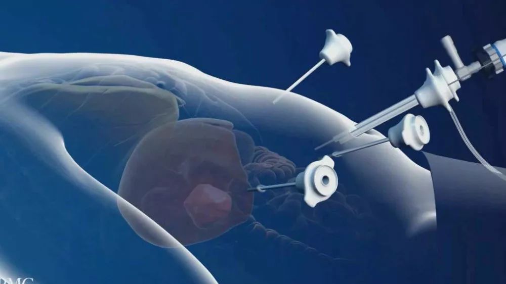 微创手术一定要用等离子刀吗,手术一定是开刀吗