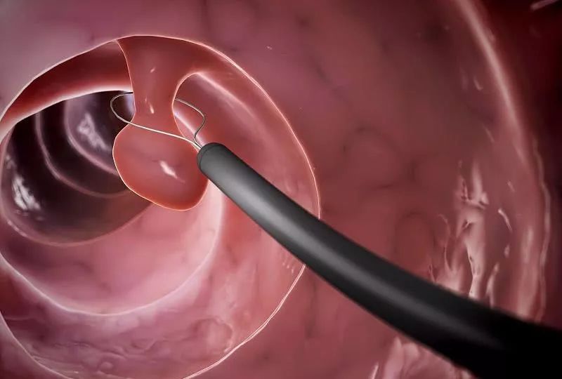 大肠有息肉用手术吗,大肠长息肉了怎么办