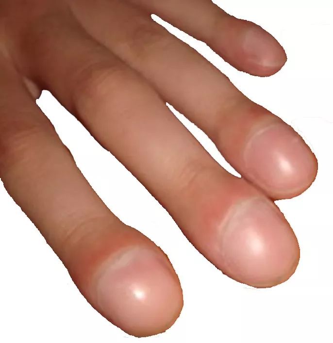 直立性低血压患者,直立性低血压症状