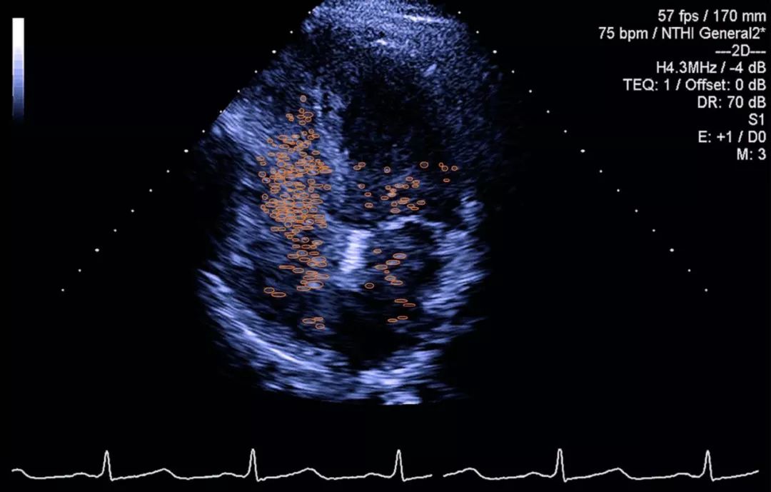 直立性低血压患者,直立性低血压症状