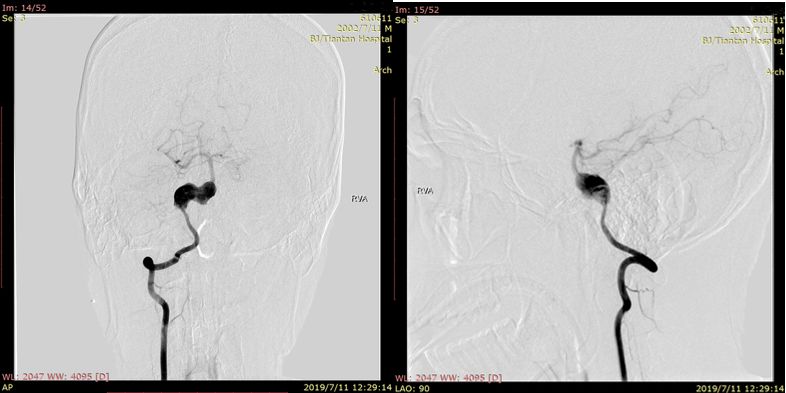 夹层动脉瘤治疗指南,复杂的1型夹层动脉瘤手术