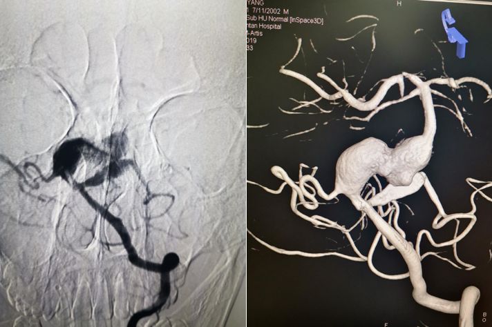 夹层动脉瘤治疗指南,复杂的1型夹层动脉瘤手术