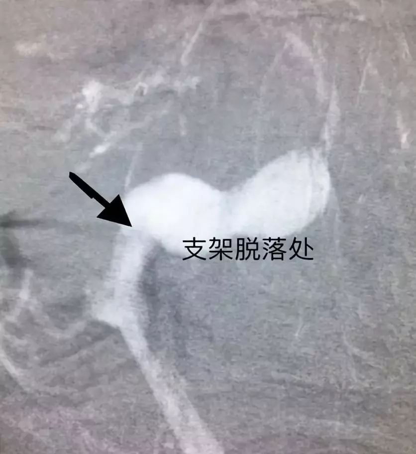 夹层动脉瘤治疗指南,复杂的1型夹层动脉瘤手术