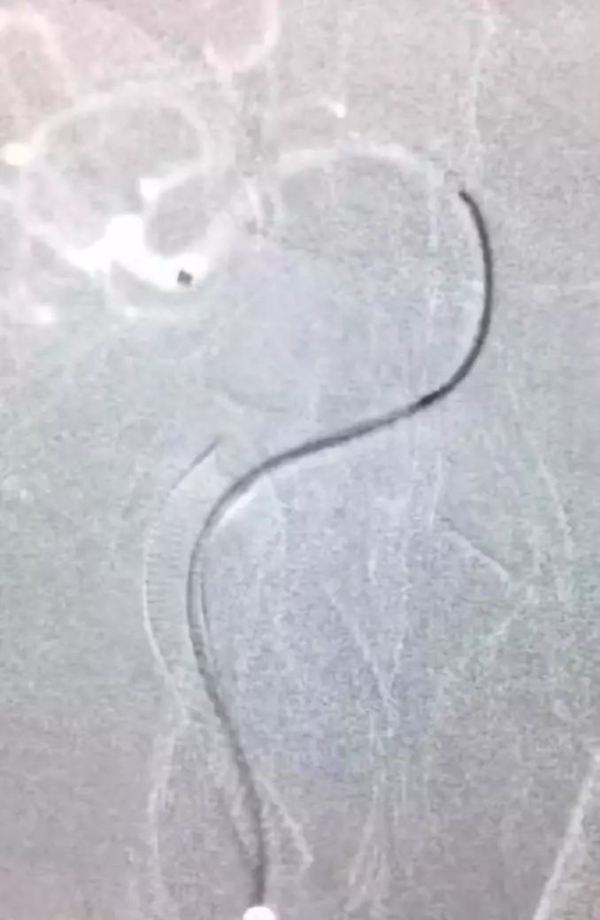 夹层动脉瘤治疗指南,复杂的1型夹层动脉瘤手术