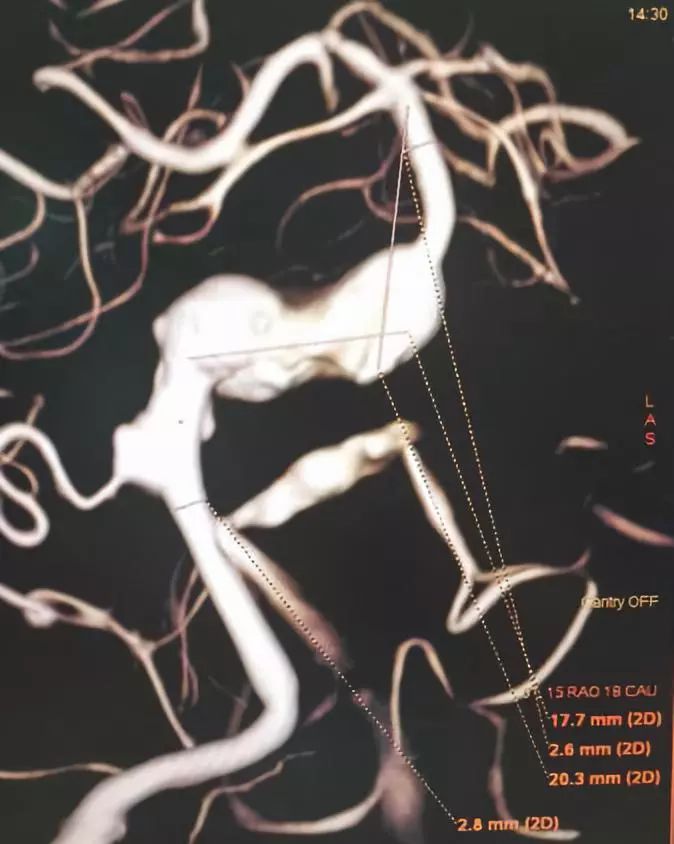 夹层动脉瘤治疗指南,复杂的1型夹层动脉瘤手术