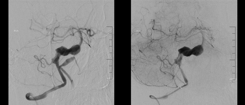 夹层动脉瘤治疗指南,复杂的1型夹层动脉瘤手术