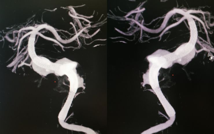 夹层动脉瘤治疗指南,复杂的1型夹层动脉瘤手术