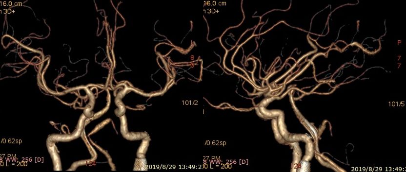 夹层动脉瘤治疗指南,复杂的1型夹层动脉瘤手术