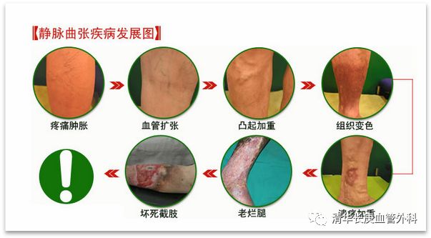 胃底静脉曲张,睾丸静脉曲张