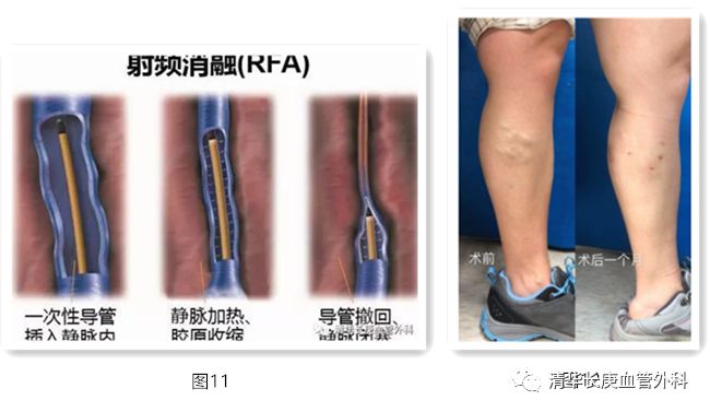 胃底静脉曲张,睾丸静脉曲张