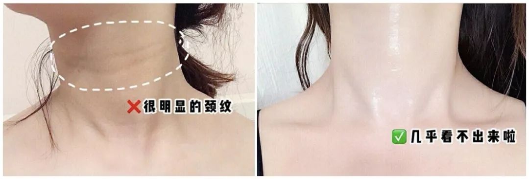 这款急救弹性蛋白贴,每天一片赶走干纹,还你天鹅美颈