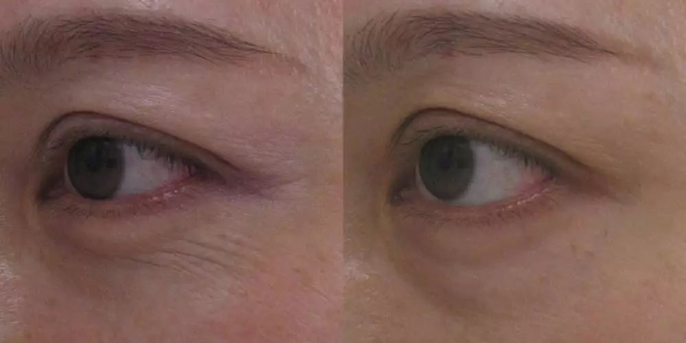 这款急救弹性蛋白贴,每天一片赶走干纹,还你天鹅美颈