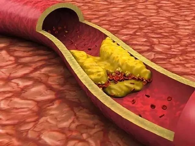 体检发现颈动脉斑块得重视,体检发现颈动脉斑块需要复查吗