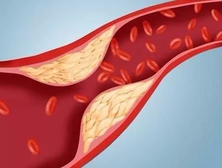 体检发现颈动脉斑块得重视,体检发现颈动脉斑块需要复查吗