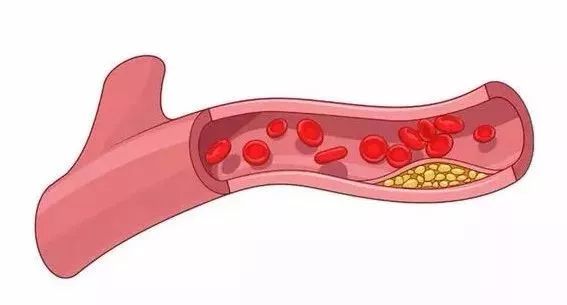 体检发现颈动脉斑块得重视,体检发现颈动脉斑块需要复查吗