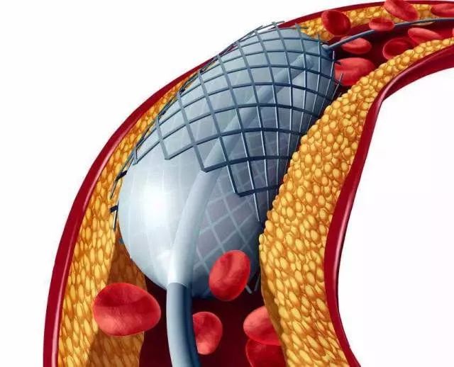 体检发现颈动脉斑块得重视,体检发现颈动脉斑块需要复查吗