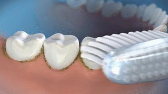 洗牙神器是真的管用,洗牙神器去牙结石永久有效果